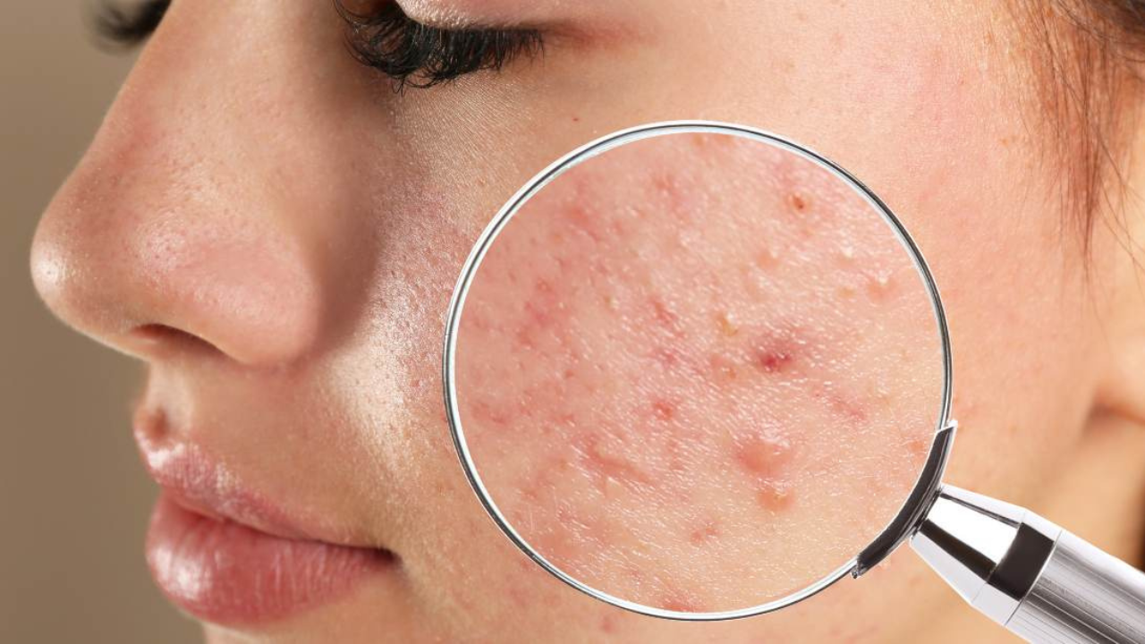 فرق آکنه با جوش 3